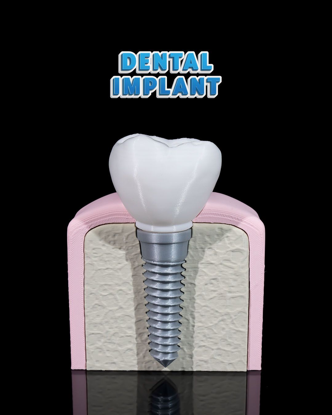Dental Implant